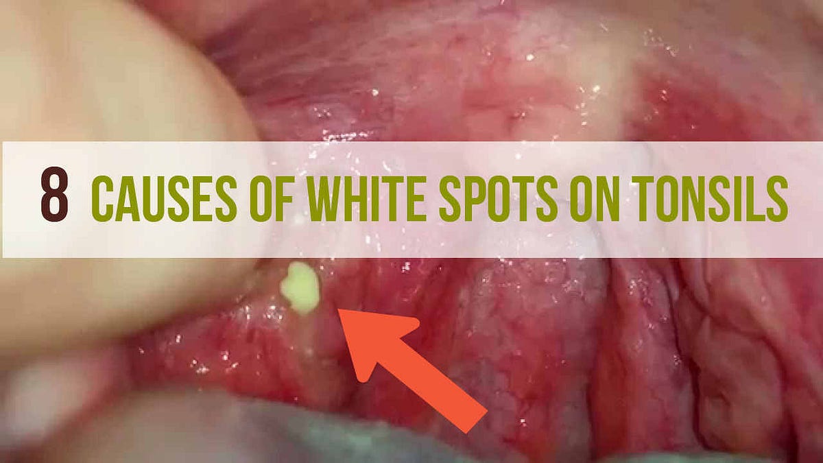 8 Causes of White Spots On Tonsils That You Need to Know by Sanjeev