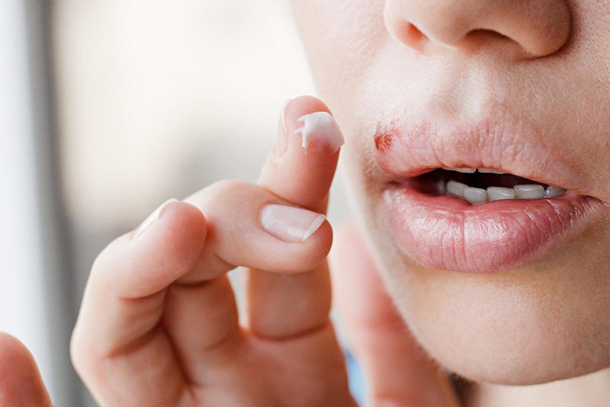 How to treat a cold sore. Do you or someone you know have