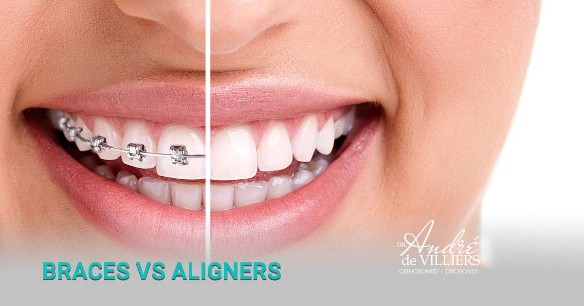 Invisible vs. metal braces — which perform best? by Cape Town