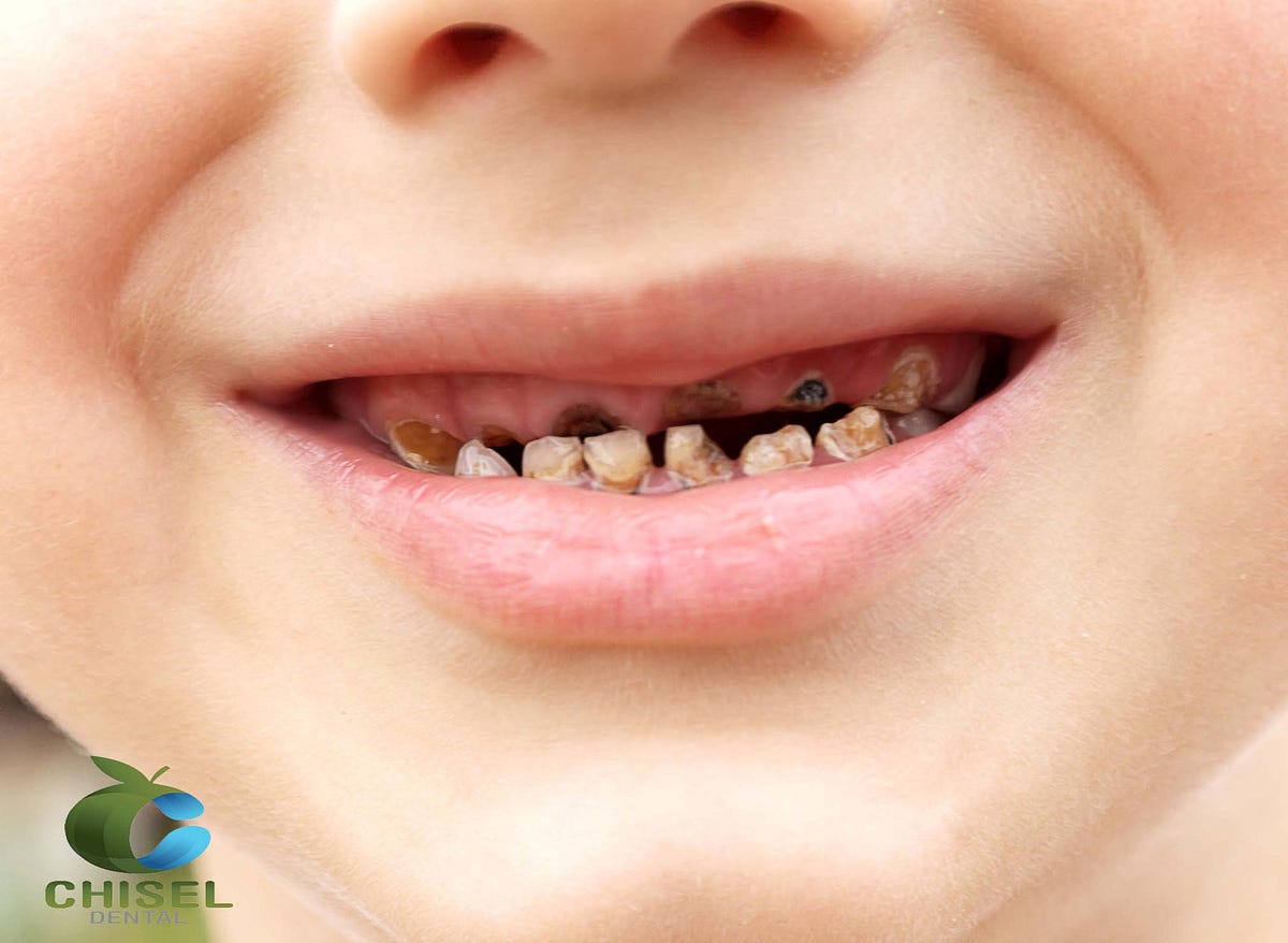 Chisel Dental Clinic How To Prevent Tooth Decay by Chisel Dental