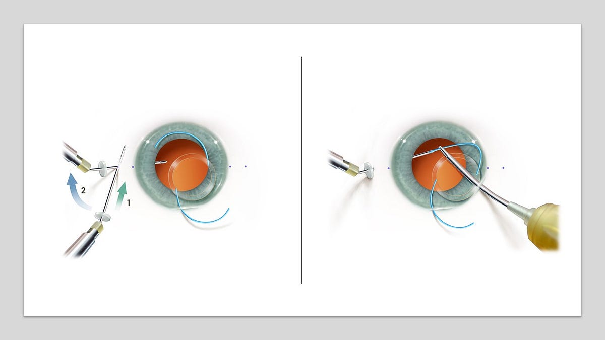 MST’s New Scleral IOL Fixation Solutions Kit Standardizes the Yamane
