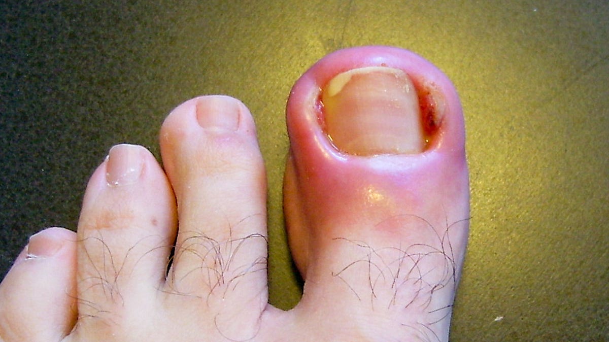 Why Does Toenail Fall Off Abruptly, What and How to Treat It? by