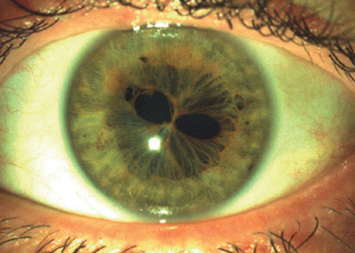 Headline Two Pupils in One Eye? That’s what Polycoria is and It’s