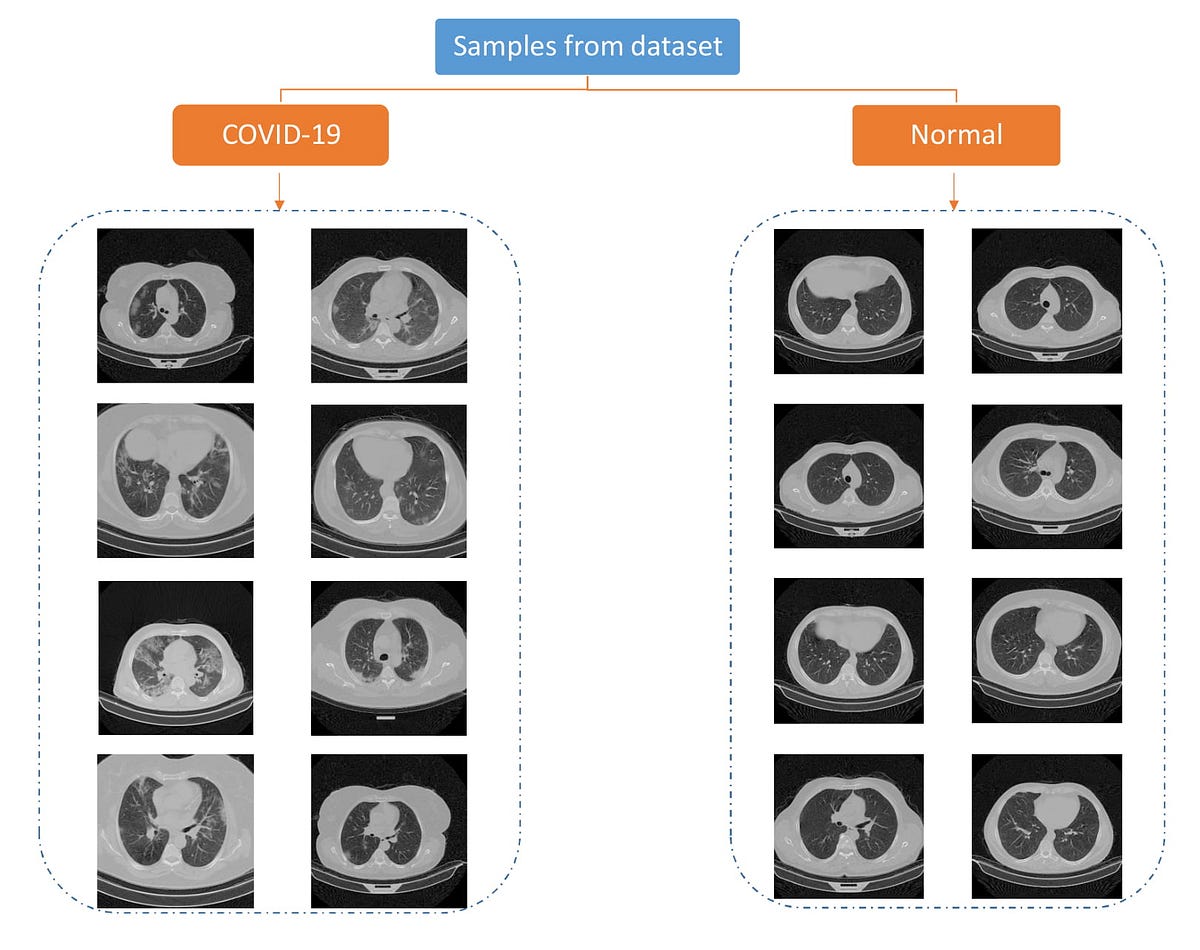 A Large Covid19 CT Scans Dataset by Mohammad Rahimzadeh