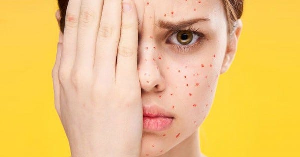 Cara Menghilangkan Bruntusan Di Jidat Secara Alami Dan Cepat