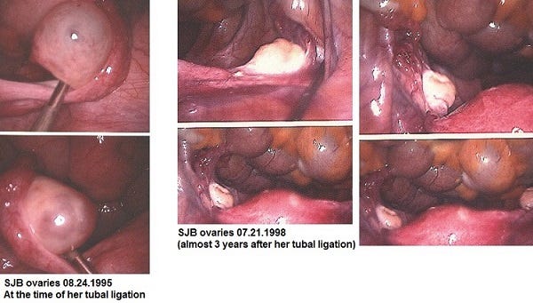 Tubal Ligation, Essure, and Filshie Clips… The Transgressions of Female