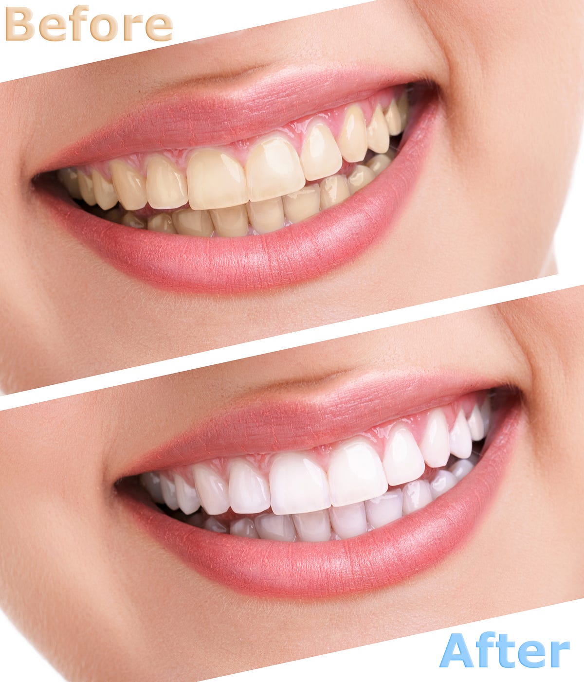 Here are Basics of Teeth Whitening Procedure by MelbourneDentist Medium