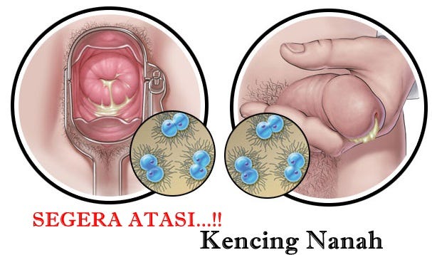 Bagaimana Cara Untuk Menyembuhkan Nanah Keluar Dari Kemaluan Pria | by  Denature Herbal 13 | Medium