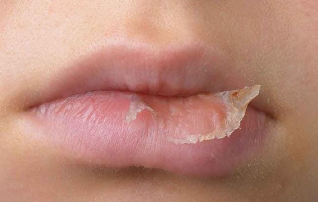 What are the Remedies for Hives and Eczema on the Lips? by Nav Gosal