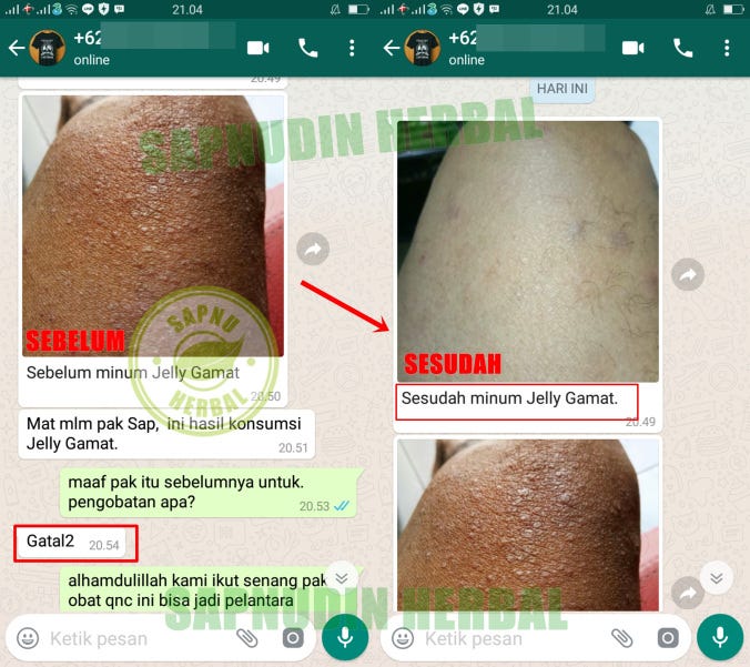 Cara Mengobati Gudik Dengan Bahan Alami