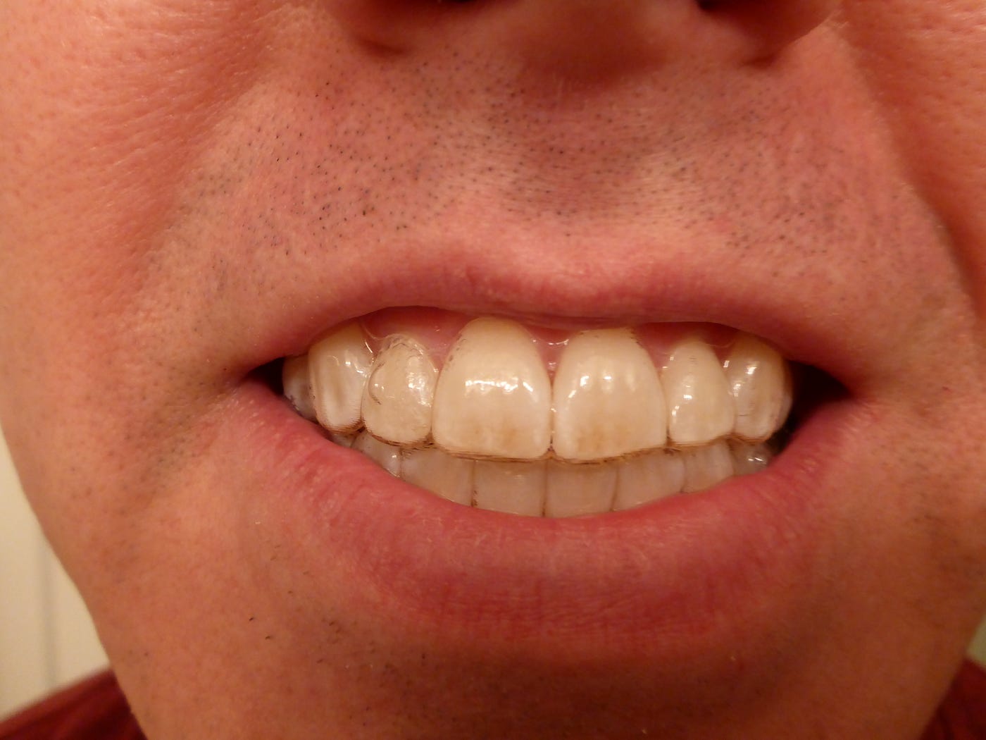 invisalign attachment removal enamel damage lefeldismael