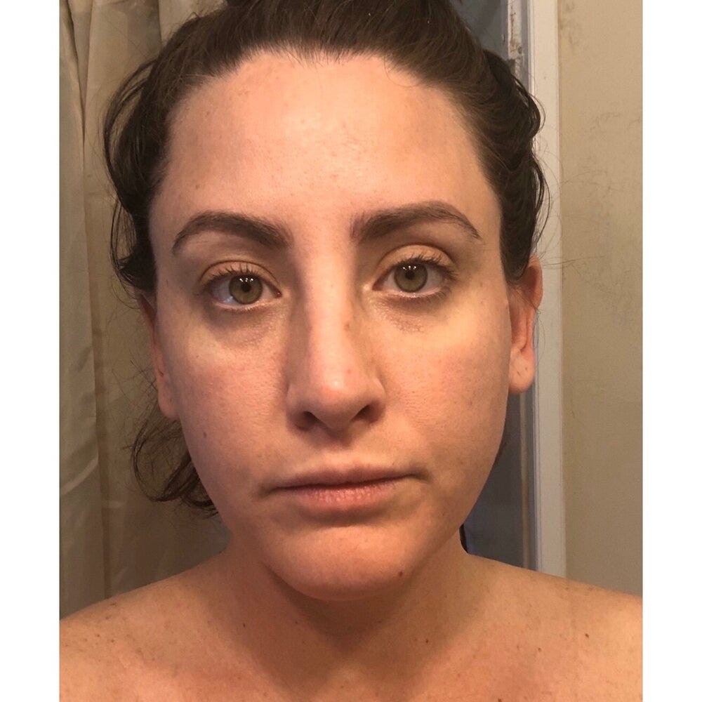 One Year Ago I Had My Breast Implants Removed, and Here’s What I Have