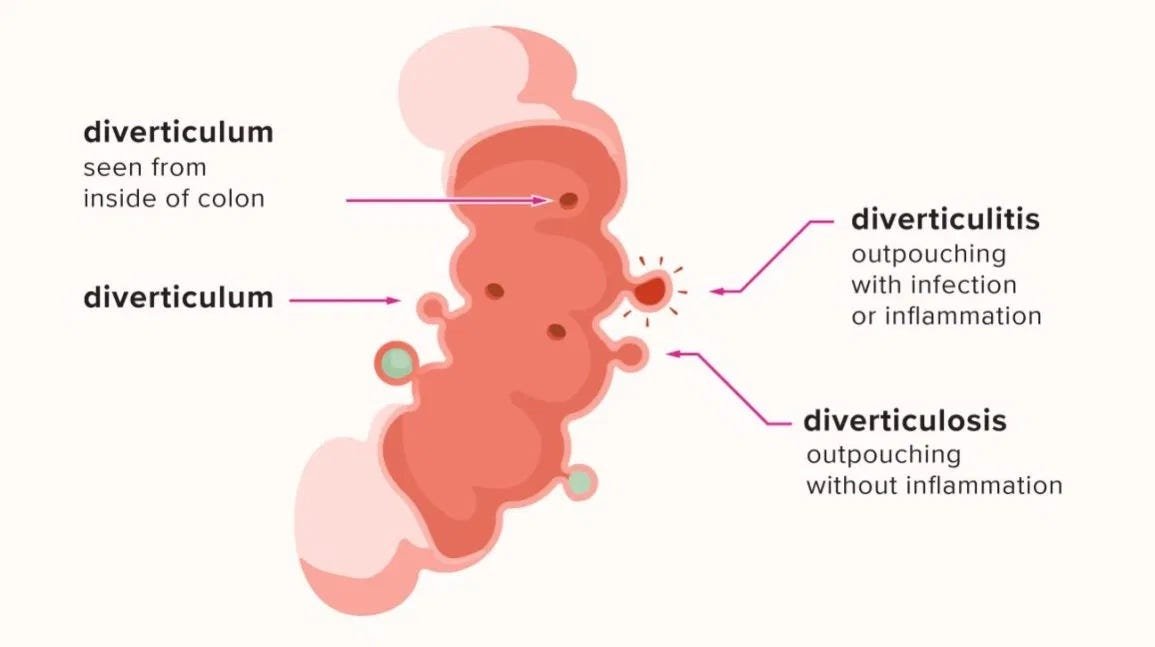 The Long Road Diverticulitis. My husband was diagnosed