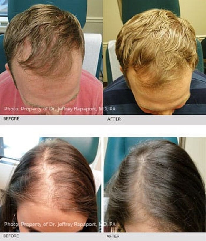 Platelet Rich Plasma (PRP) Hair Loss Therapy in Minneapolis Platelet Rich Plasma (PRP) Hair Loss Therapy in Minneapolis