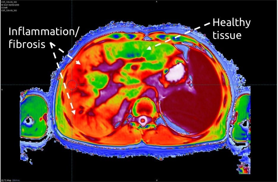Multiparametric Resonance Imaging (MRI) as a Safe, Non