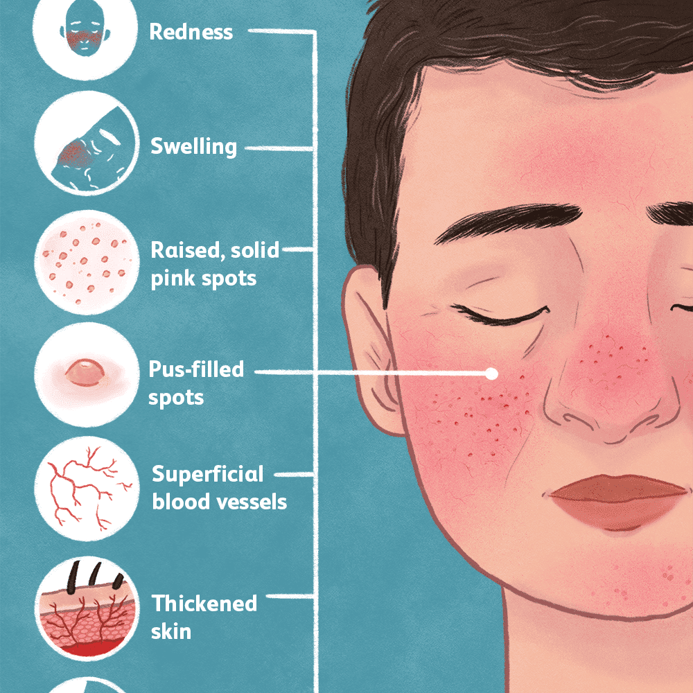 Rosacea — Know It All!. All you need to know about Rosacea. by Clipo Medium