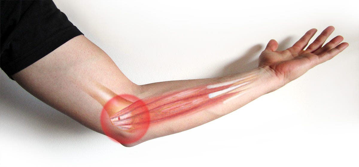 What Are the Common Golfers Elbow Symptoms? Annabelle Kaberry Medium