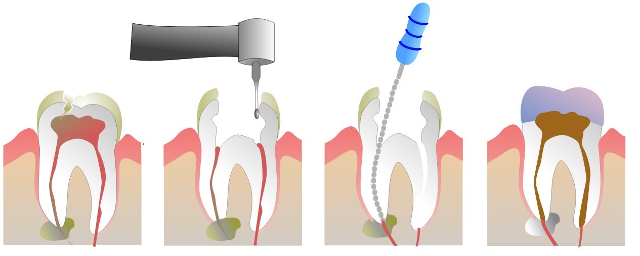 PAIN AFTER ROOT CANAL. WHAT DOES IT INDICATE? by DENTAL ORB Medium