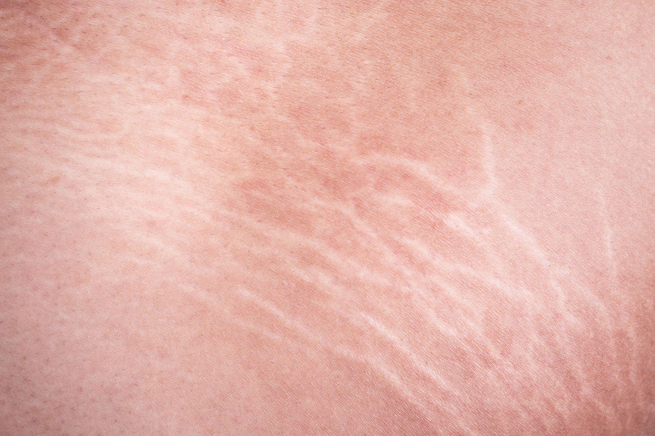 Stretch Marks — Causes, Treatment and Prevention. by Renita Rajan