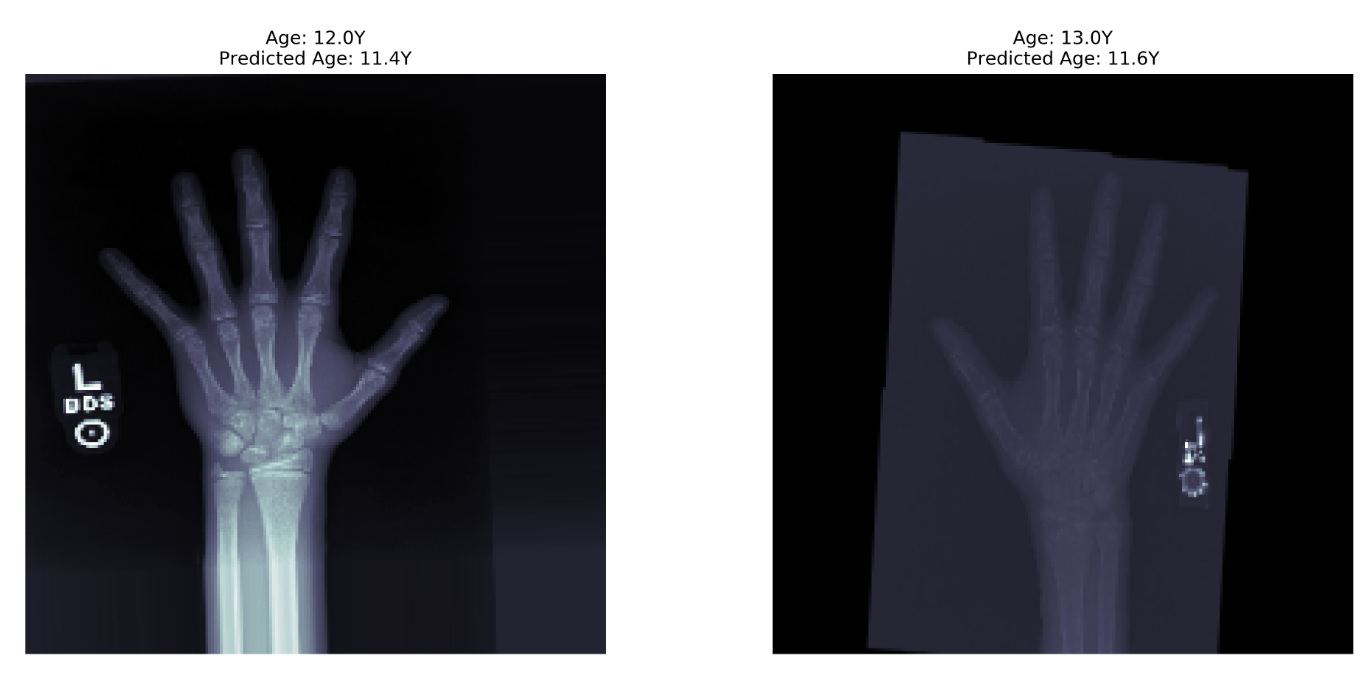 Bone age prediction through xray images by Inside