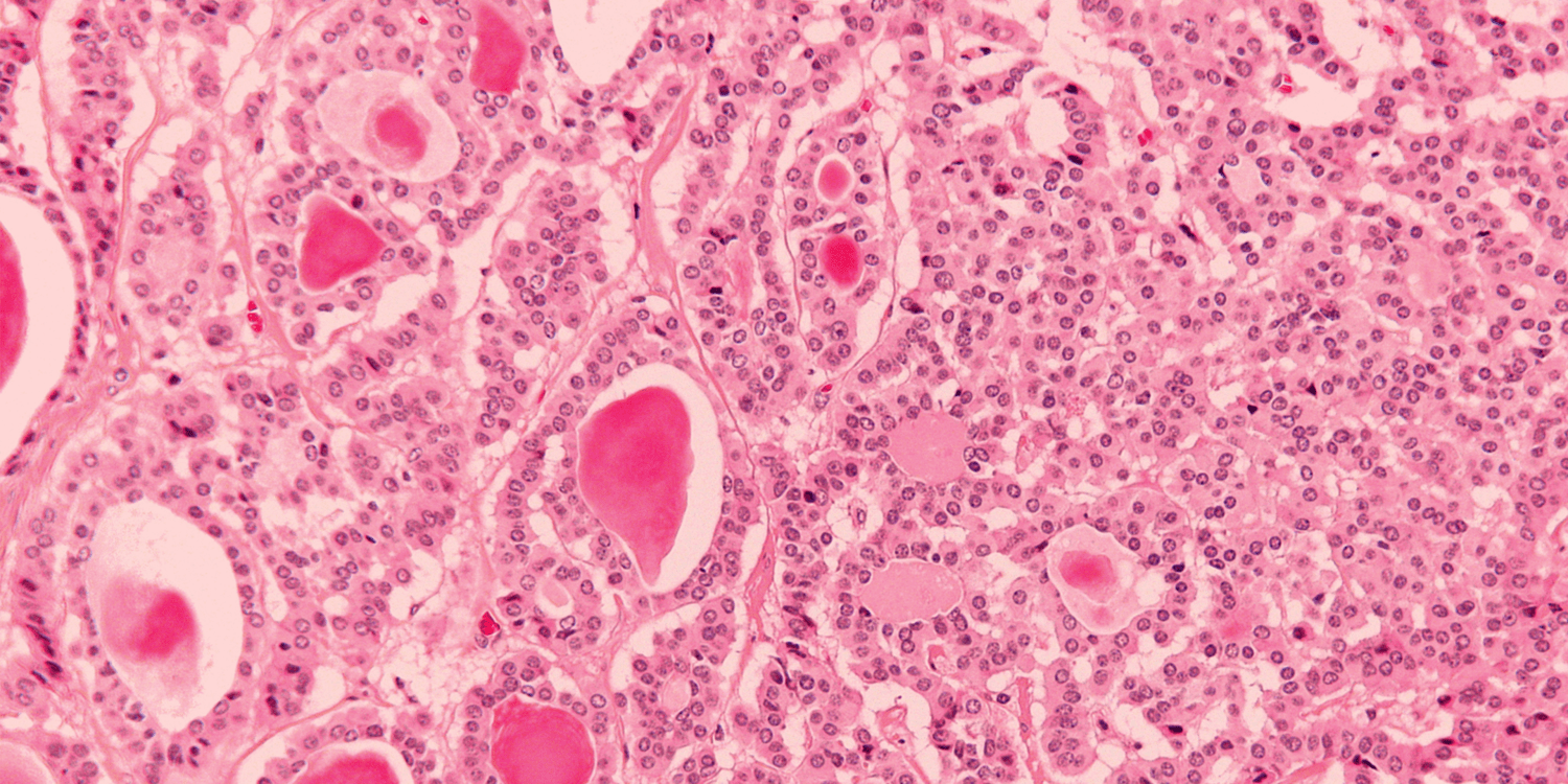 Neuroendocrine tumors. Neuroendocrine tumors are rare… by Dr