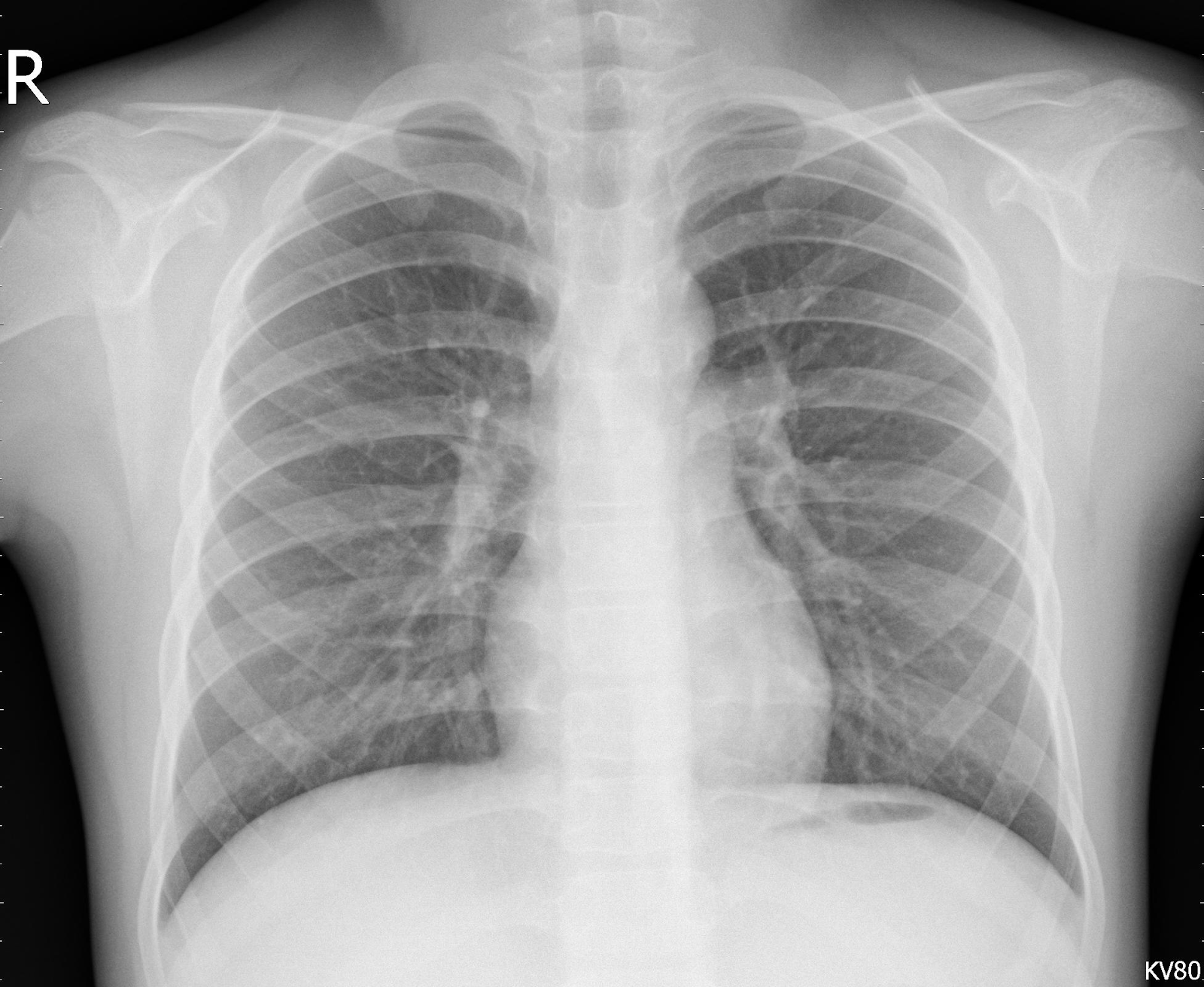 Detecting pneumonia on Xray images — and Transfer Learning