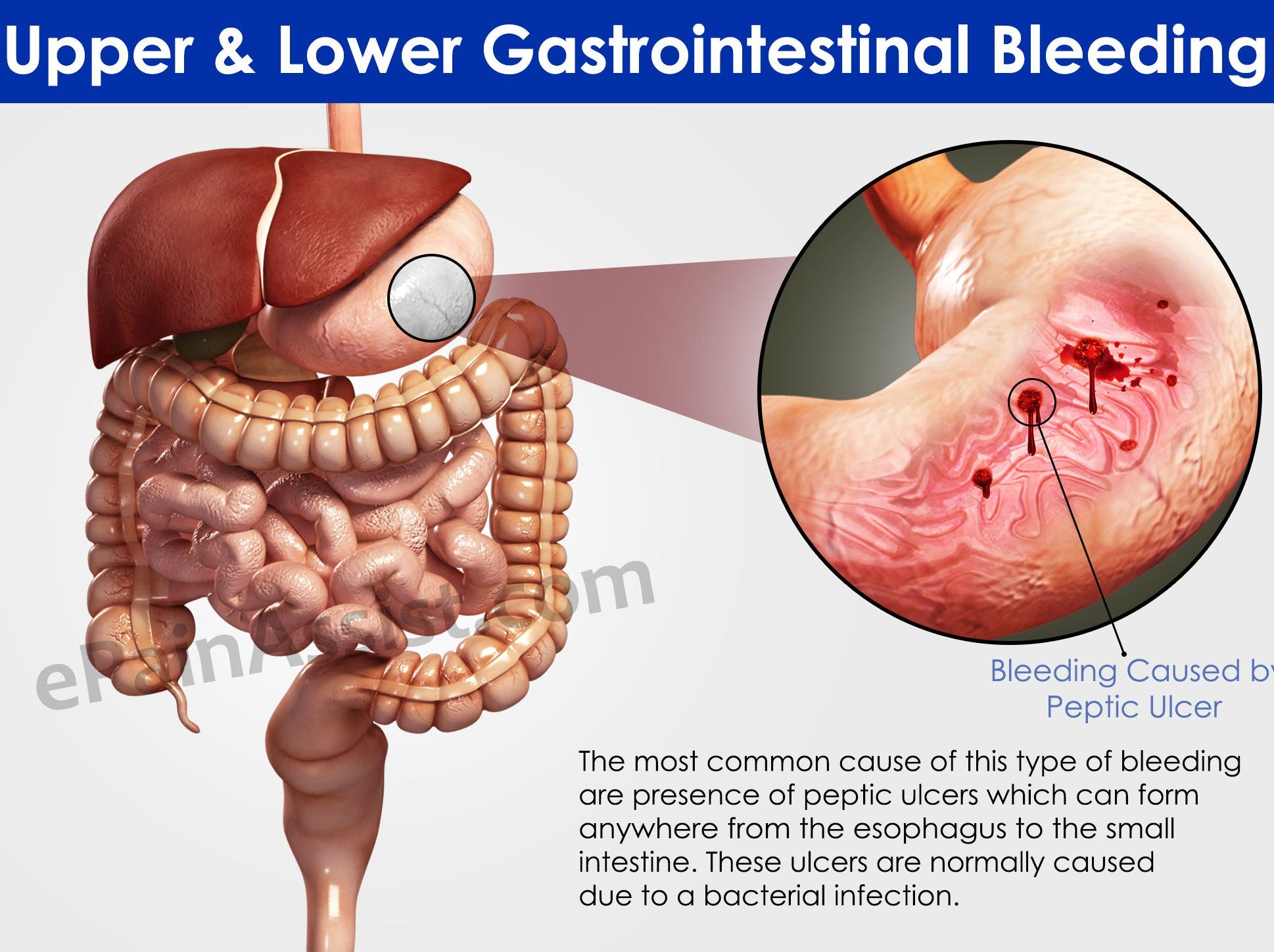 Surgery for Obscure Lower Gastrointestinal Bleeding in India