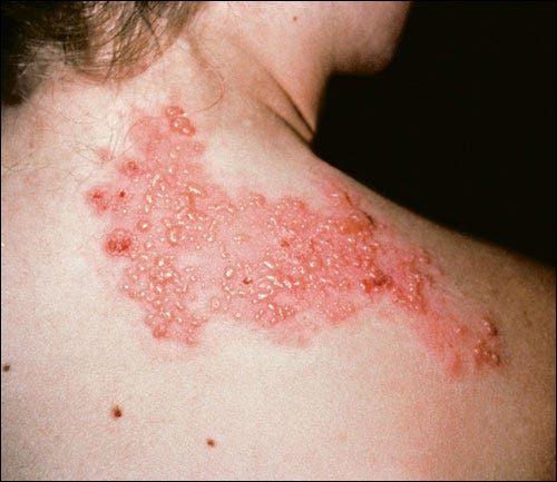 Apakah Penyakit Herpes Kulit Menular | by Atasi Herpes Alami | Medium