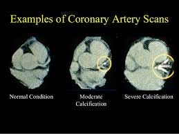 Why You Must Know If Your Heart Calcium Score Is Zero | By Joel Kahn | Medium