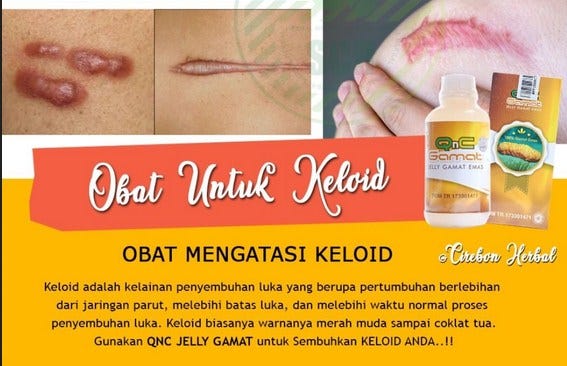 Apa Itu Keloid Dan Cara Mengatasinya