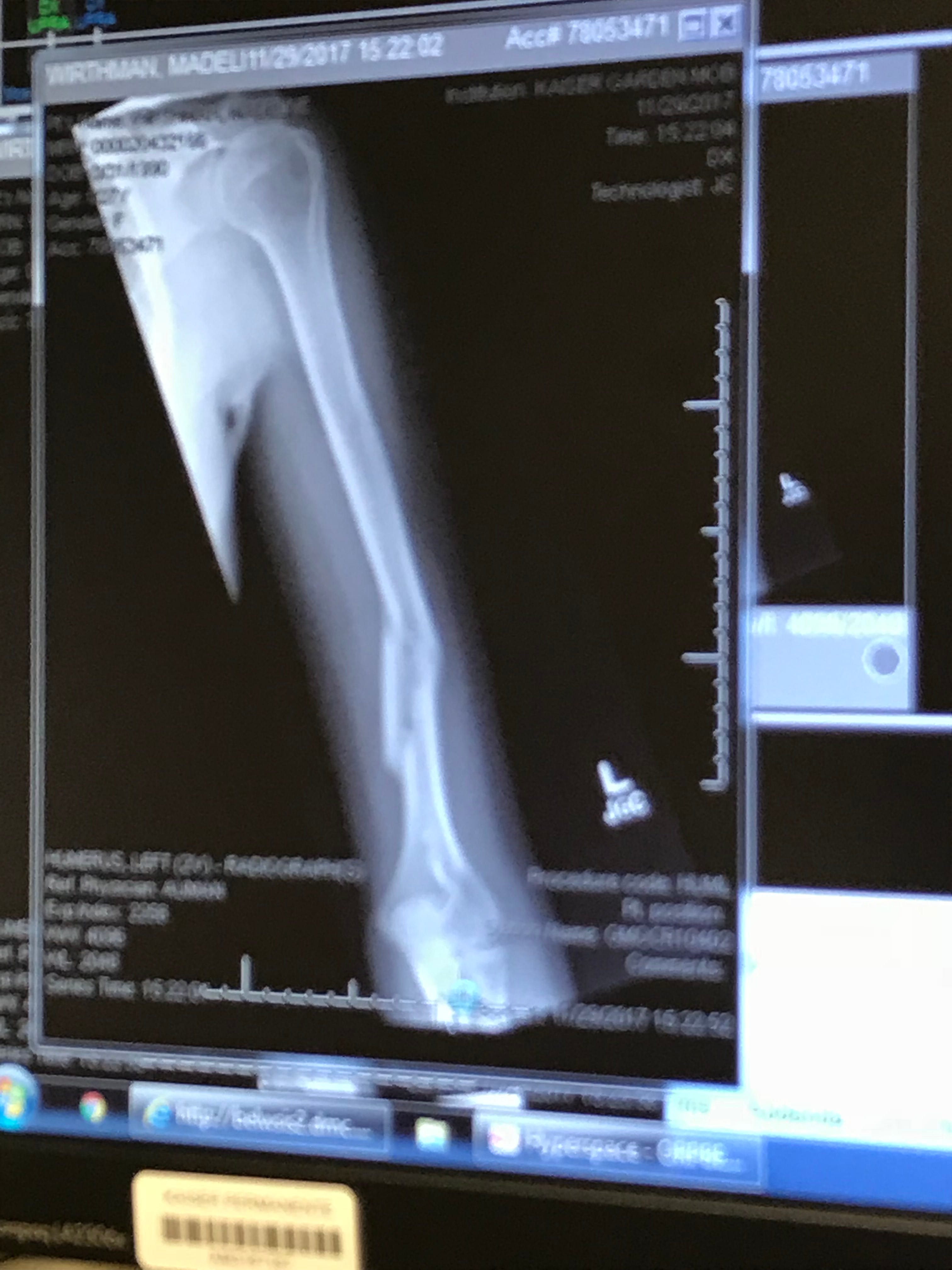 A Broken Humerus — Road to Recovery by Maddie Wirthman