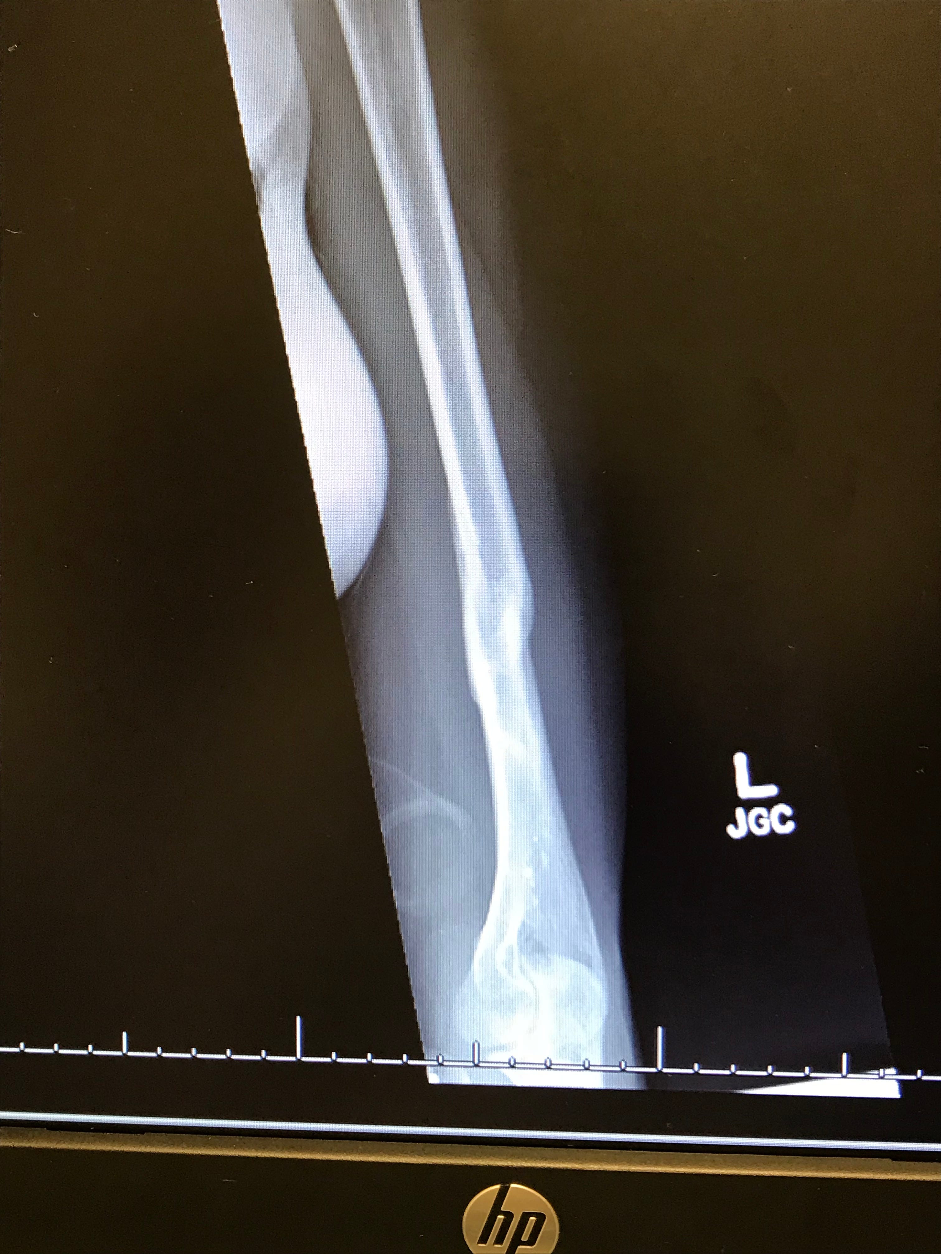 A Broken Humerus — Road to Recovery by Maddie Wirthman Medium