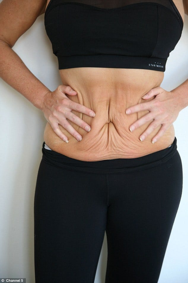 Weight Loss Loose Skin Prevention and Top 10 Remedies
