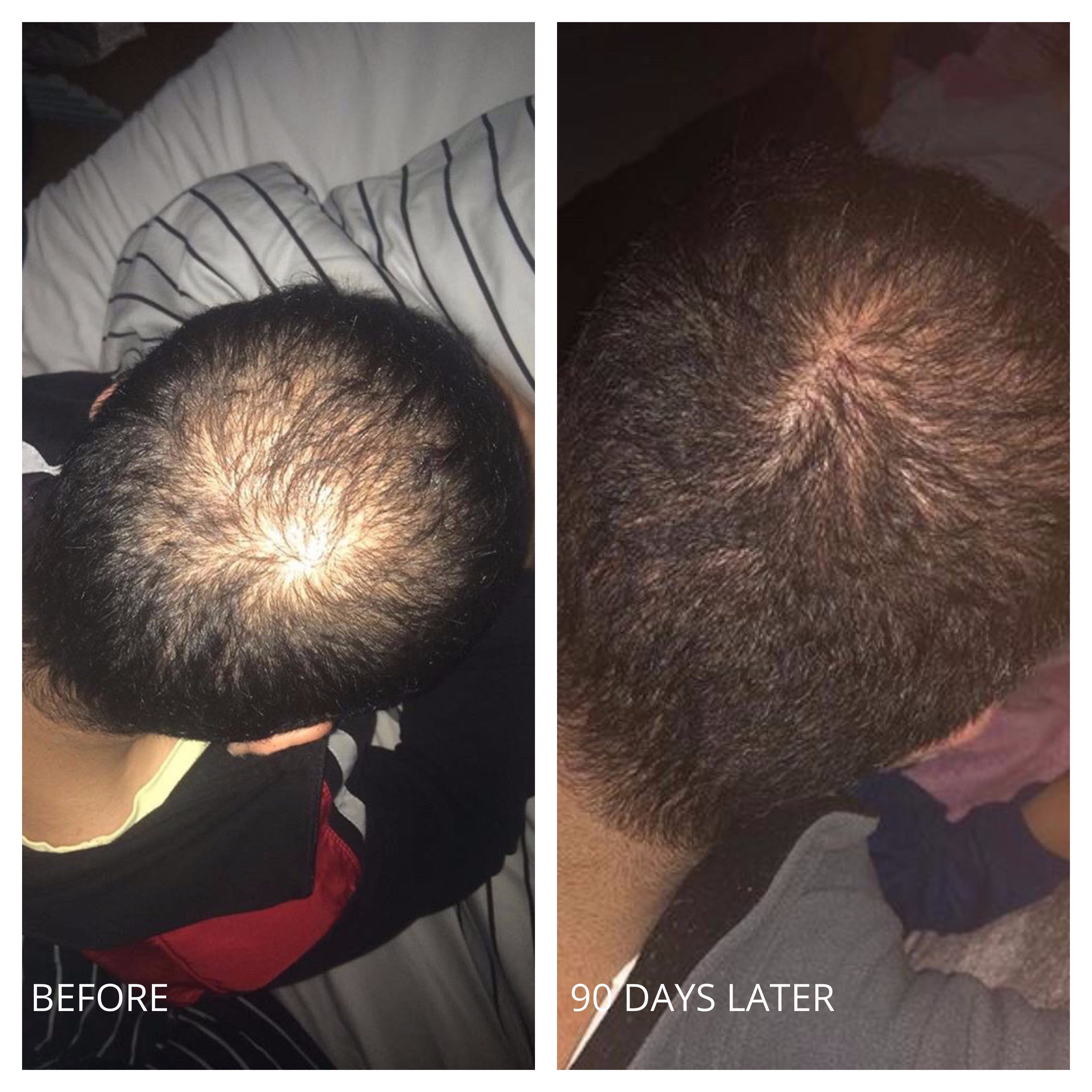 6 of The Best Ways To Remove DHT from The Scalp [2020 Update] by It
