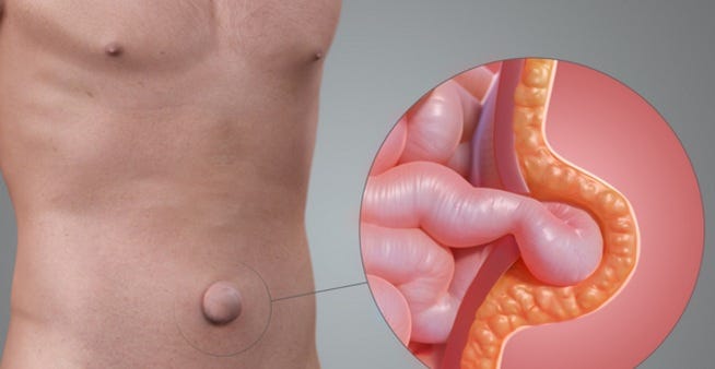 OBAT HERNIA TANPA OPERASI (RESMI BPOM) 085869319693