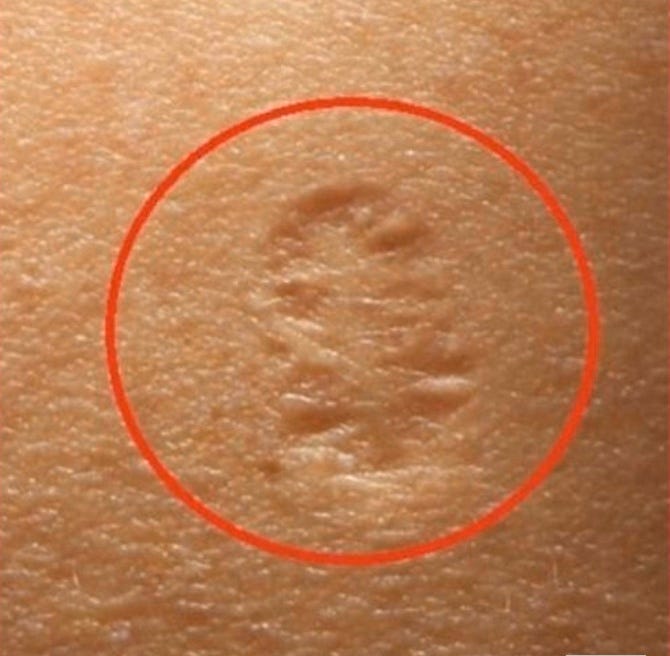 The Truth Behind The Small Scar On The Upper Left Arm And Its Real Meaning