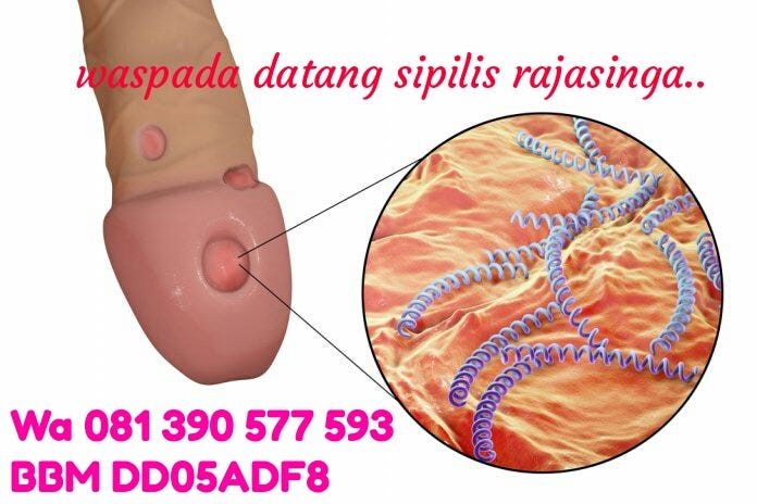 Obat Sipilis dan Kencing Nanah di Rawalumbu Bekasi | by galih randi | Medium