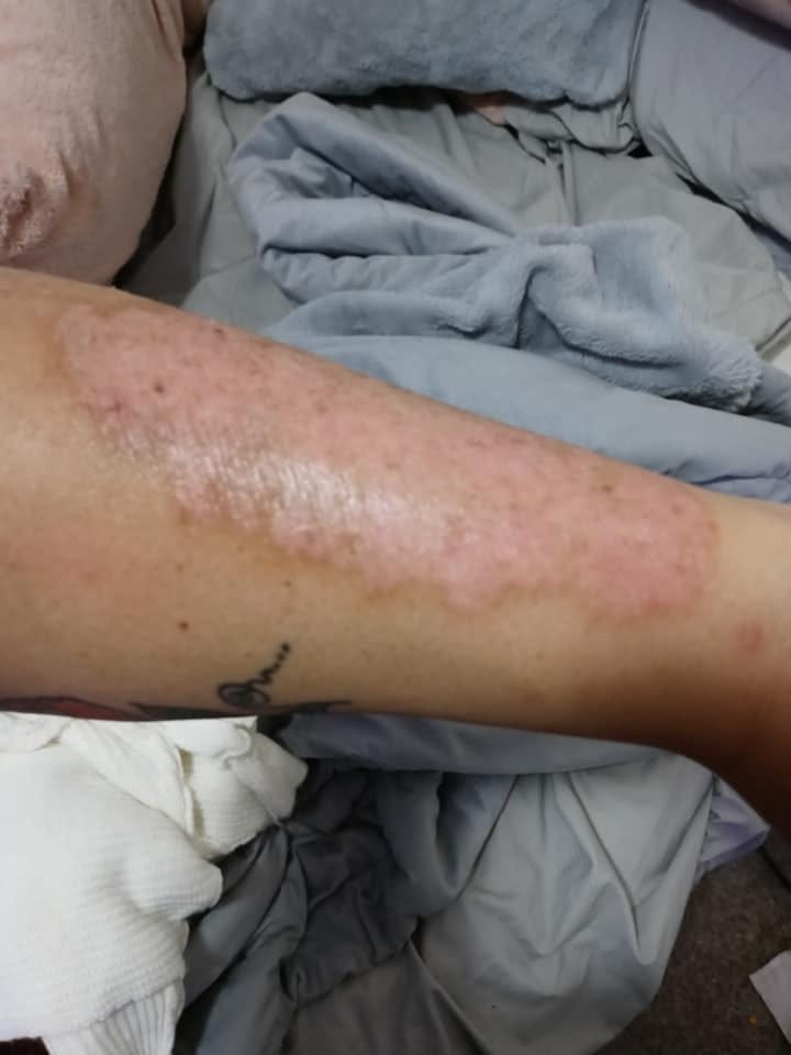 Psoriasis Bleeding Treatment ?. If the psoriasis skin is torn and… by