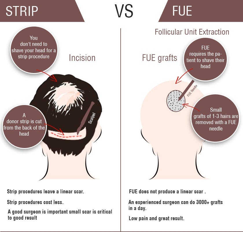 Most Common Types of Hair Transplant Hair Transplant Most Common Types of Hair Transplant Hair Transplant