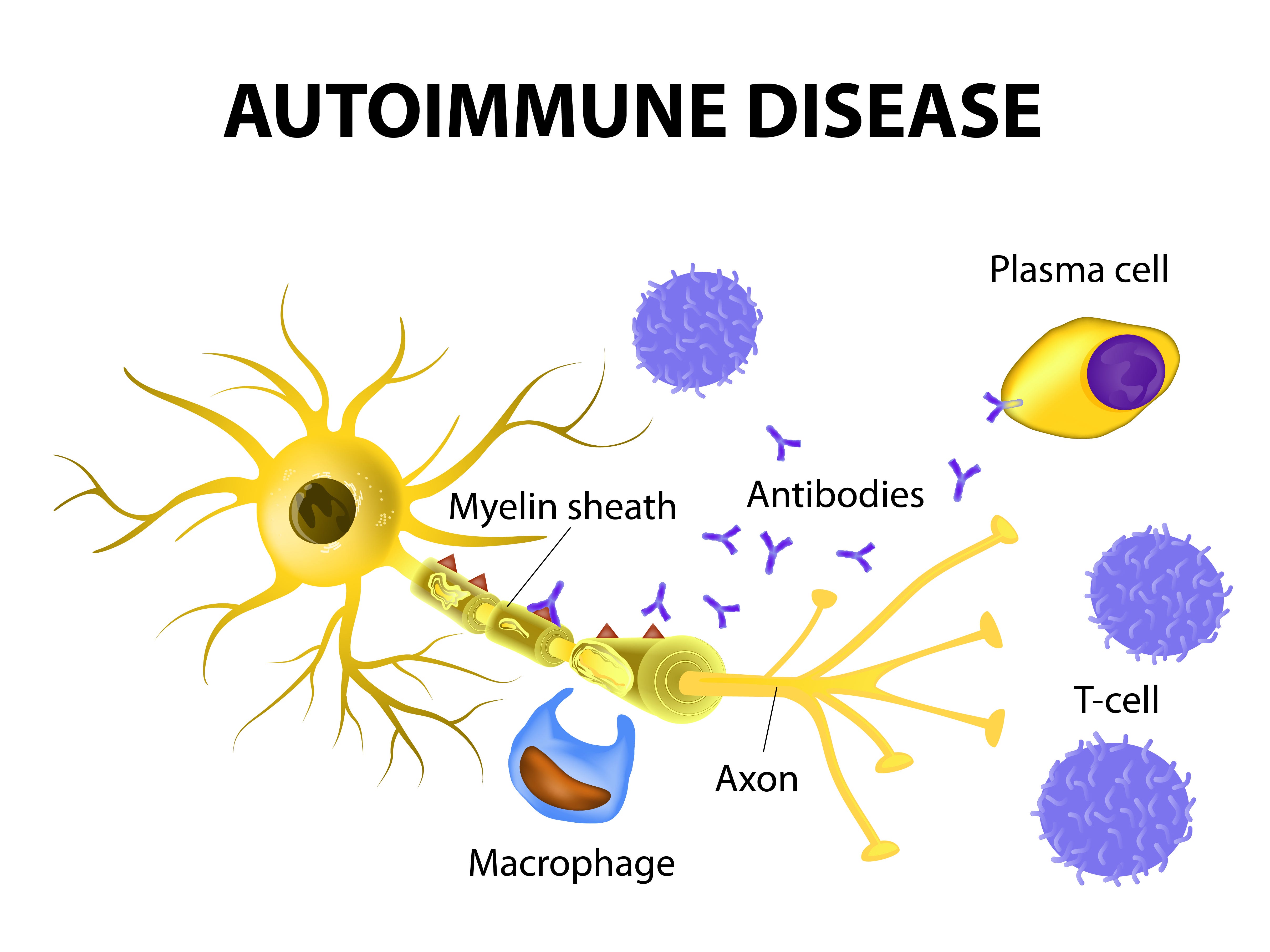 Multiple Sclerosis risk factors. Scientists are still working on