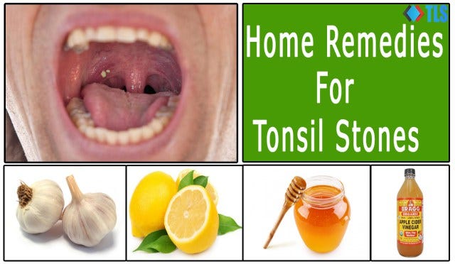 6 Simple & Effective Home Remedies For Tonsil Stones | By Sanjeev Kumar | Medium