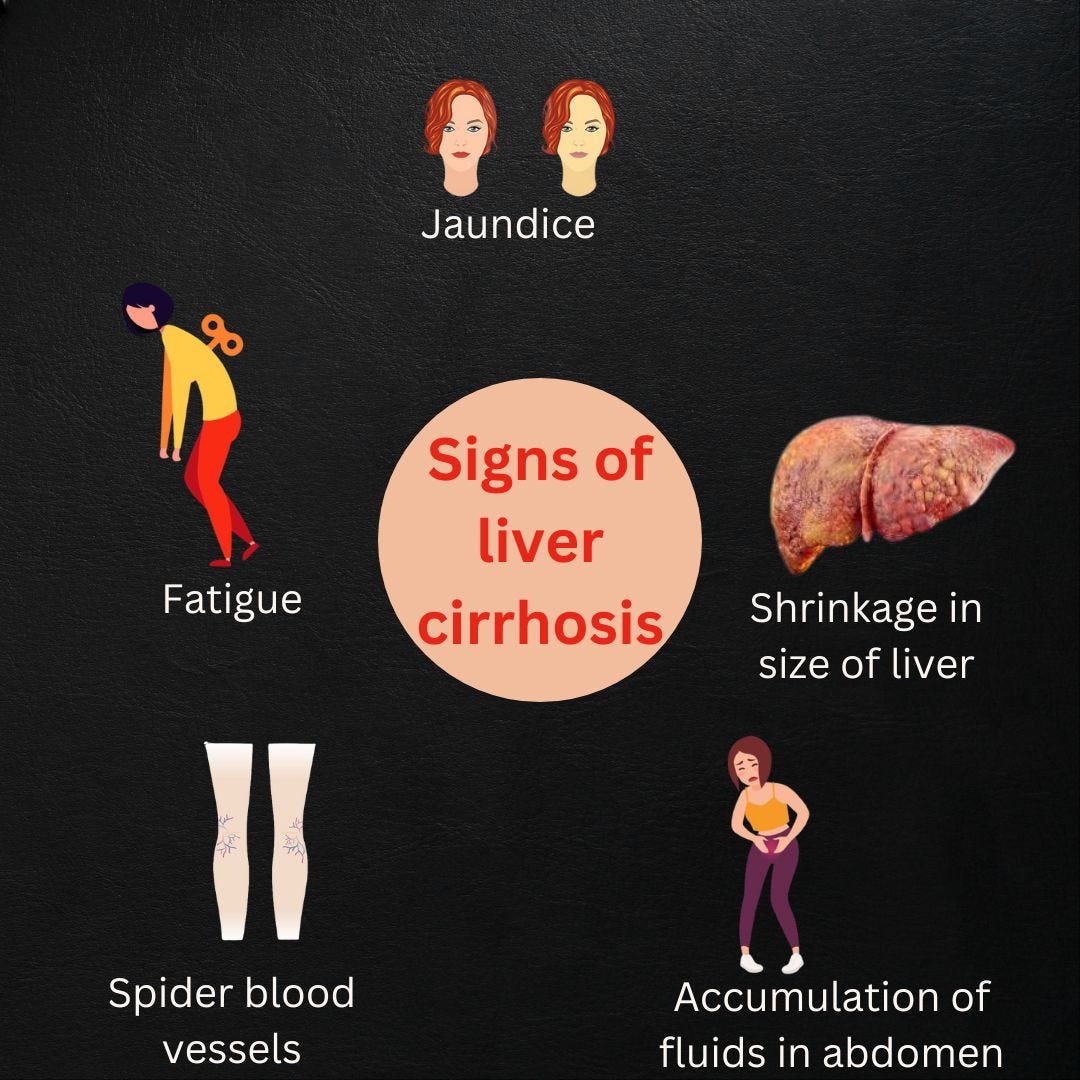 Liver cirrhosis is a condition in which your liver is deeply damaged by