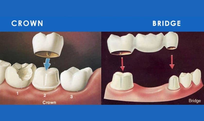 Best Dental Crowns and Bridge In Pune Dental Crown In Shivaji Nagar
