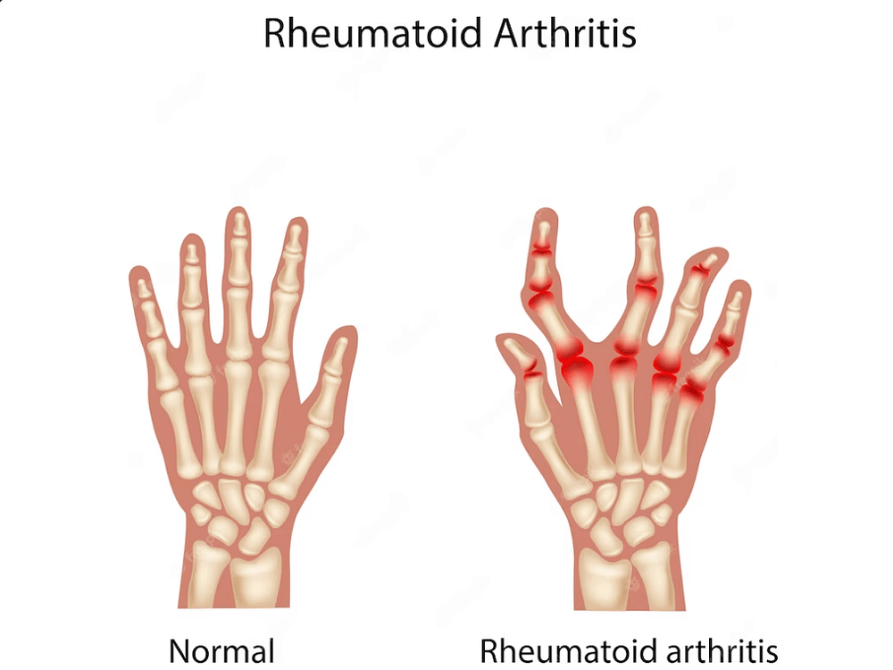 The Rheumatoid Arthritis Diet Food to Eat and Avoid by Sonam Mehta