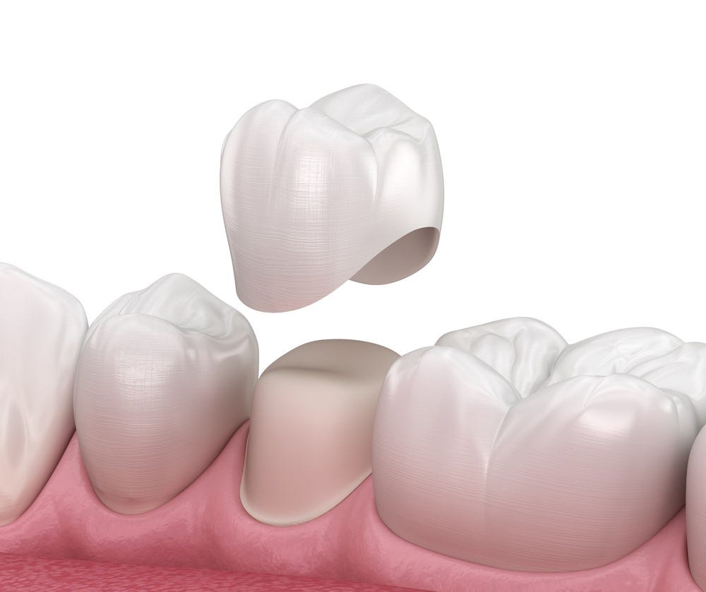 How do Dentists Fix Crowns?. Dental crowns are coverings implanted… by Clove Dental Medium