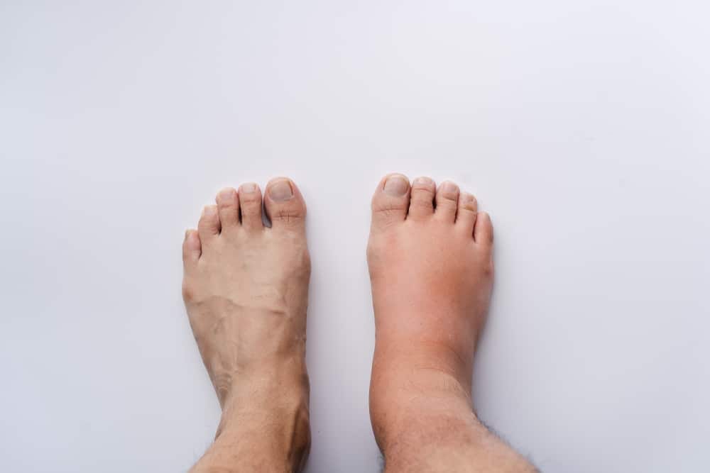 Understanding Fat Ankles Exploring the Phenomenon of Cankles from