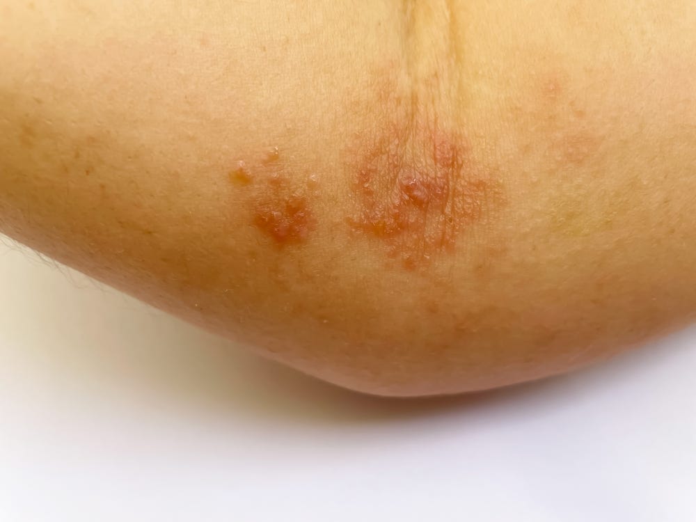 What is Post Herpetic Neuralgia? — Causes and Symptoms by Roja Arjun