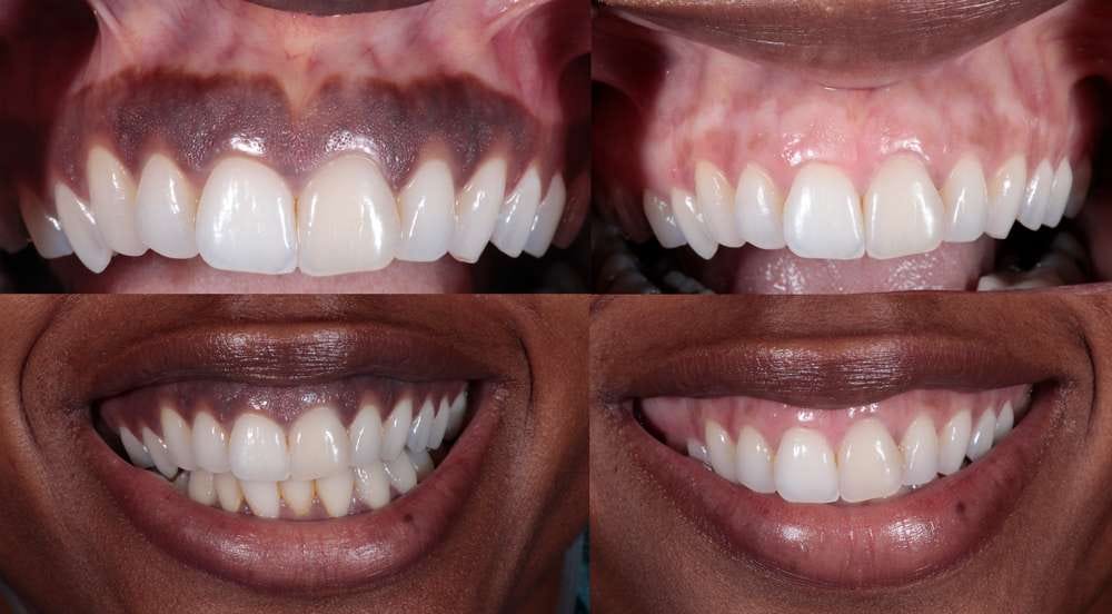 Gum Brightening 5 Tips to Lighten Your Gums Naturally? by BrtiteGums