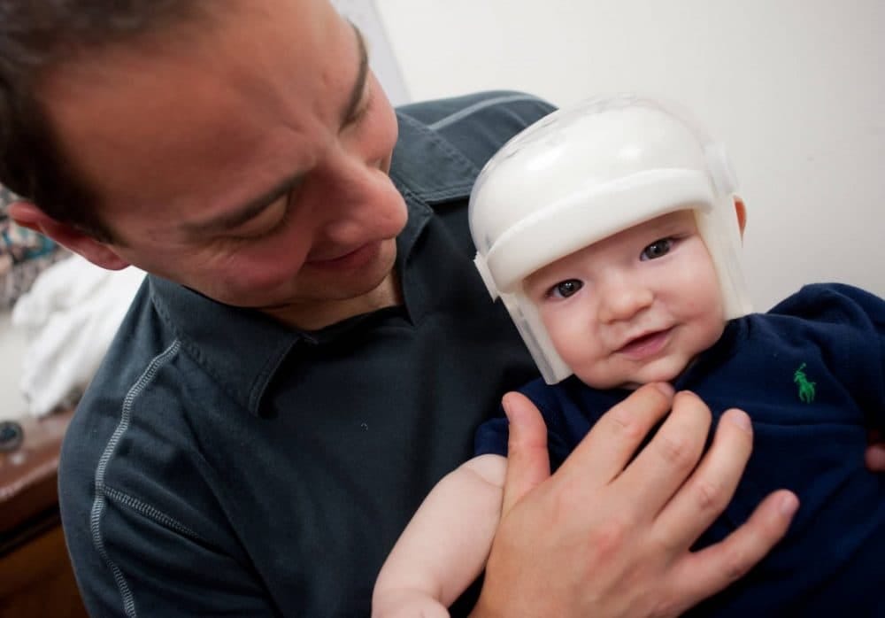 What is a plagiocephaly helmet, and how does it differ from other treatment options for flat