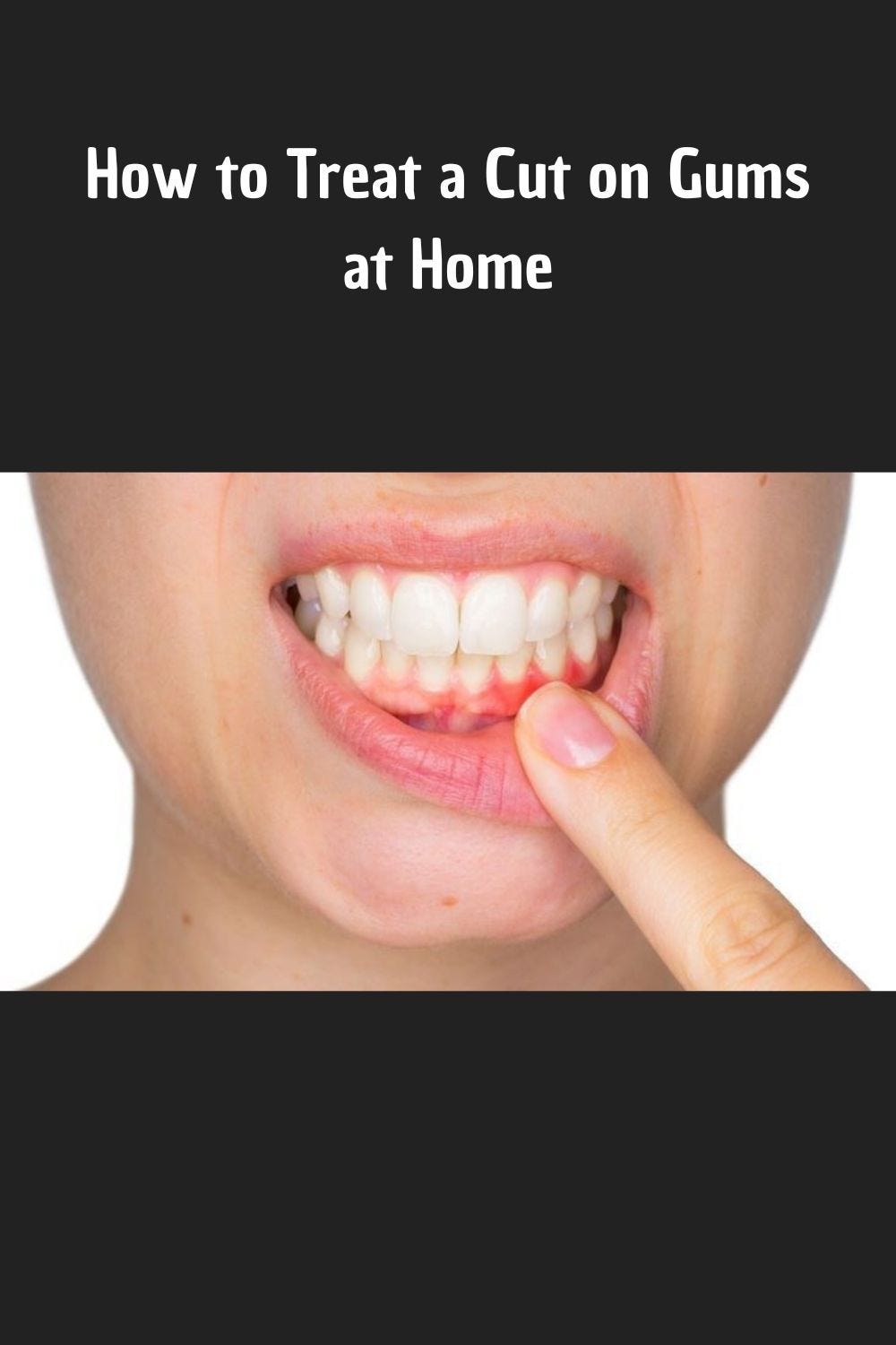 How to Treat a Cut on Gums at Home by Healthy Nation Medium